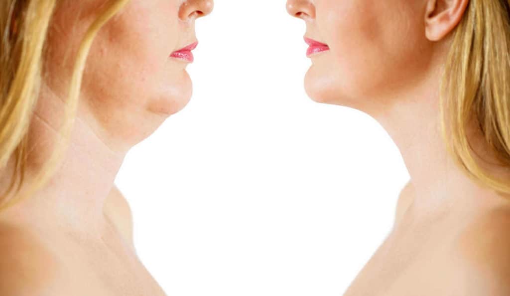 Double Chin treatment Little Bognor before and after results