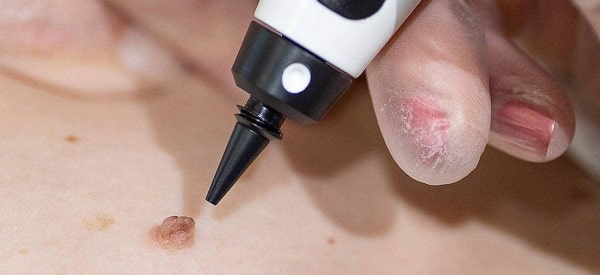 After Skin Tag Removal Little Bognor