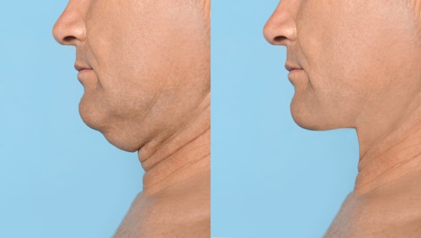 Which Non-Surgical Treatments Work Best for Jowls and Loose Skin Little Bognor?