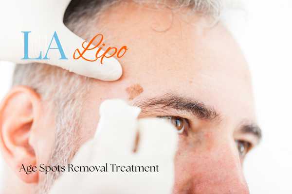 What Are the Most Effective Treatments for Age Spots Little Bognor?