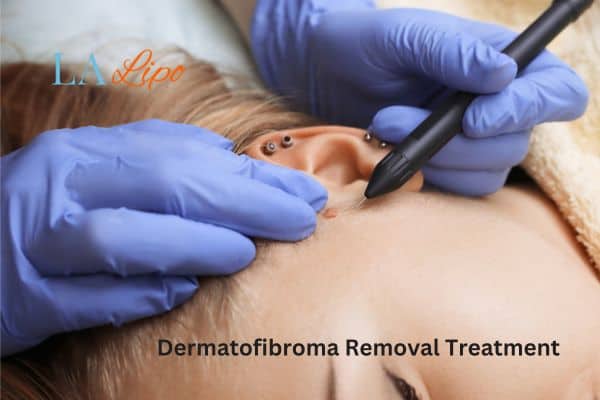 Dermatofibroma Removal Treatment Little Bognor