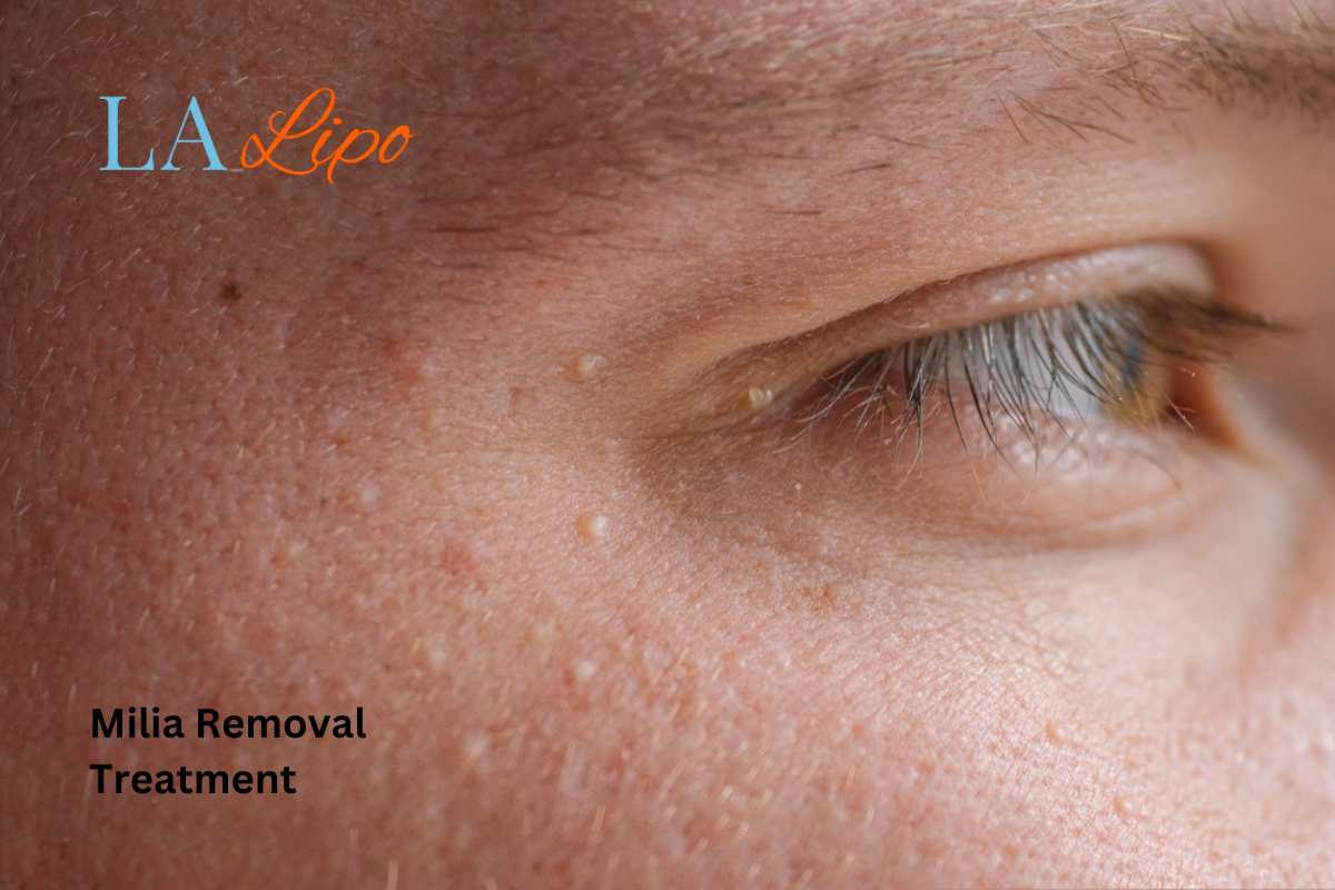 Cryopen Milia Removal: Is It the Easiest and Safest Option Little Bognor?