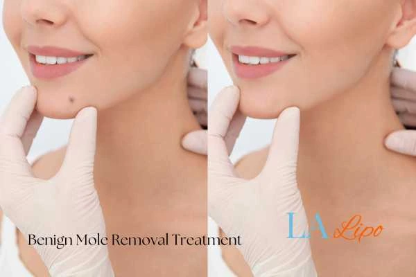 Before-and-after results following benign mole-removal treatment Little Bognor