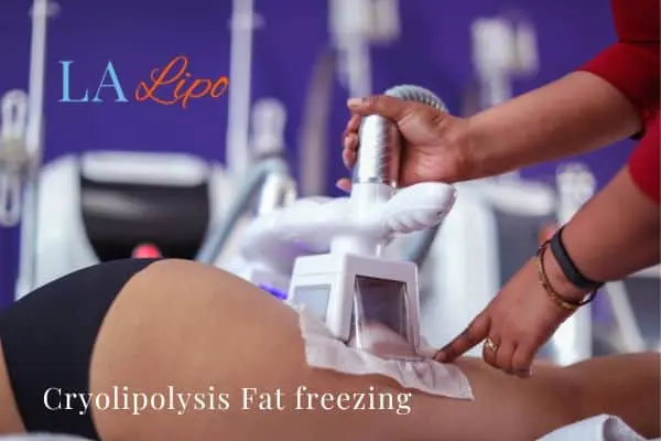 women getting fat freezing Little Bognor