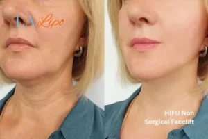 hi-fu for wrinkles Little Bognor before and after results