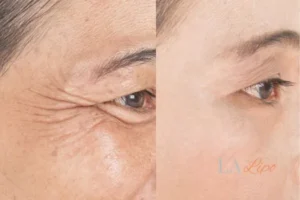 Before and after results of woman - HI-fu wrinkles reduction treatment Little Bognor