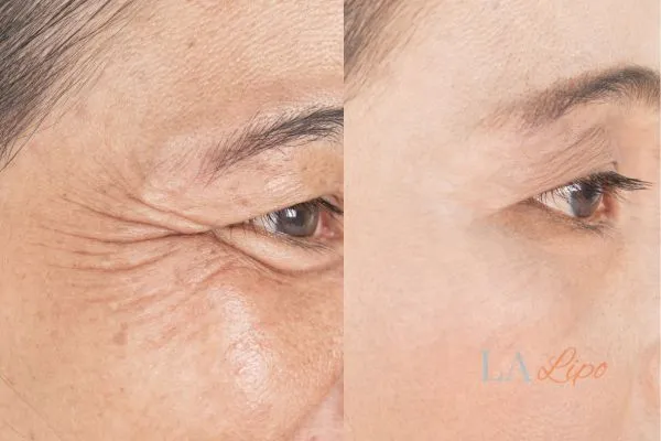 Before and after results of woman - HI-fu wrinkles reduction treatment Little Bognor