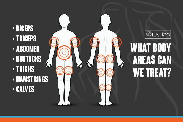 Graphic to show areas you can have LA-EMS Body Sculpting Little Bognor treatment.