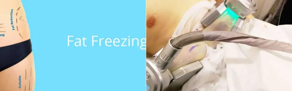 Fat freezing Little Bognor on multiple areas of the body