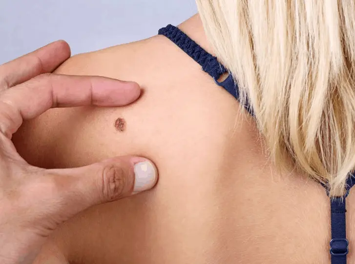 woman having mole removal Little Bognor consultation before treatment.