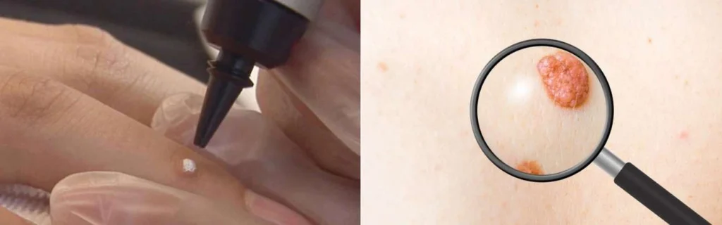 CryoPen practitioner Little Bognor assessing a benign mole before treatment