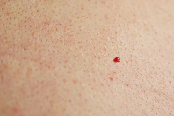 close up of a cherry angioma Little Bognor