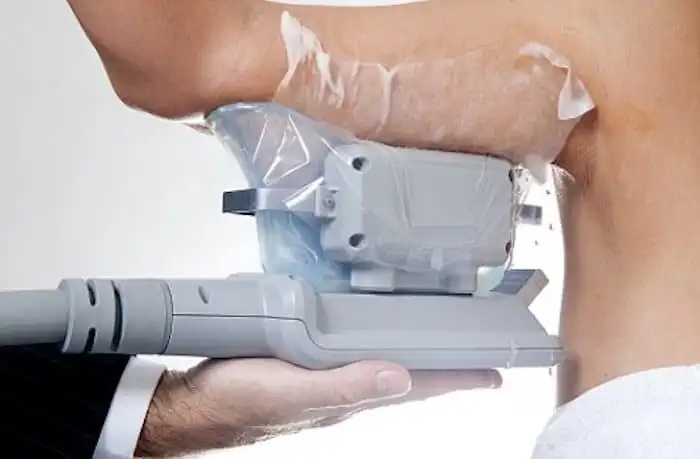 Picture of fat freezing Little Bognor on the upper arms.