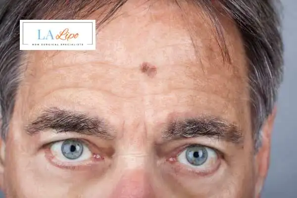 Solar Lentigo Removal Little Bognor image of man with mark on his forehead