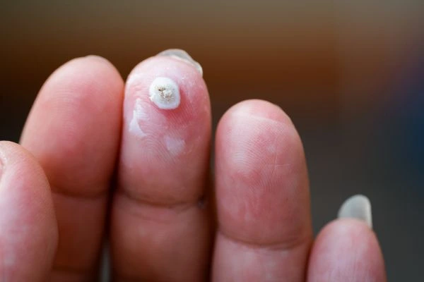 wart on person finger - cryotherapy to treat from LA LIPO Little Bognor