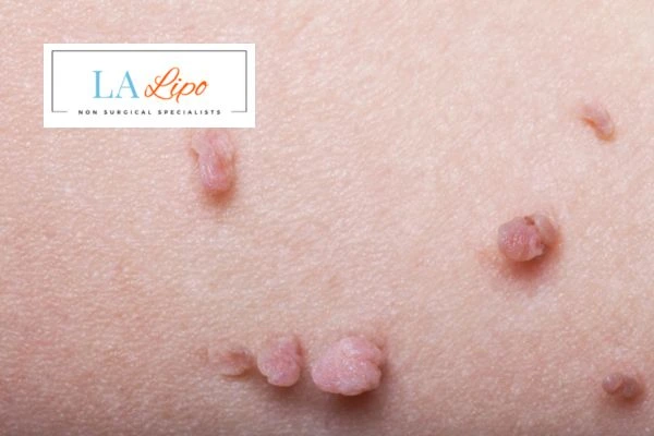 Does cryopen skin tag removal Little Bognor hurt? Find out now call our team today!