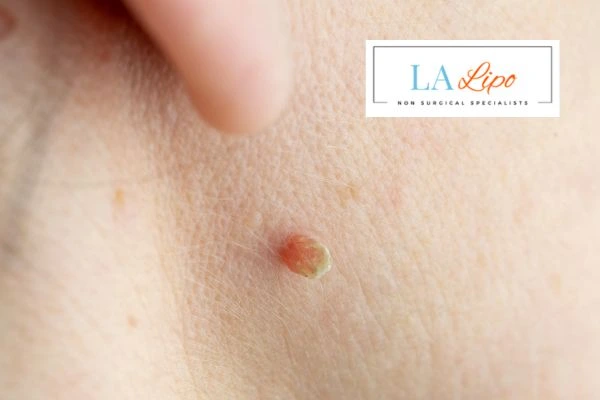 Book skin tag removal Little Bognor today speak to our team now!