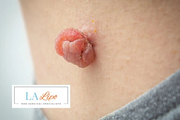 Interested in skin tag removal Little Bognor? Concerned about the pain? Find out more today!