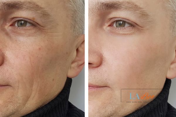 See the amazing results of Morpheus8 Treatment Little Bognor!