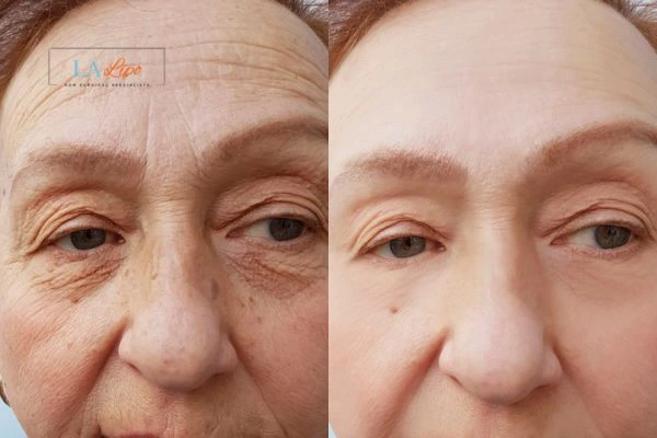The powerful benefits of Morpheus8 Treatment Little Bognor - Call Our team today!