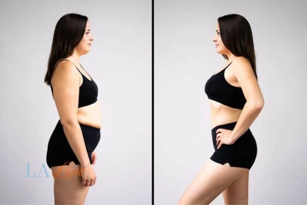 Picture of womans before and after using LA-EMS body sculpting to improve her core strength Little Bognor