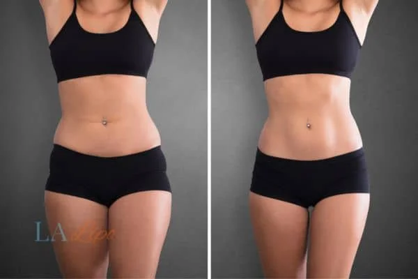 before and after results of non-surgical treatment to help a woman's body image and mental health Little Bognor