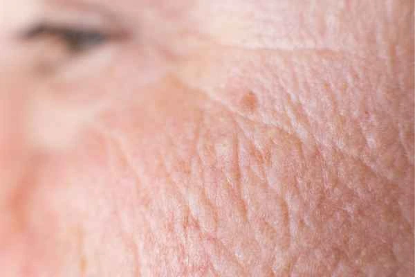 close up picture of a woman's face showing an age spot Little Bognor