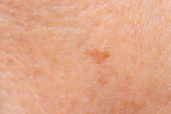 close up picture of age spots Little Bognor