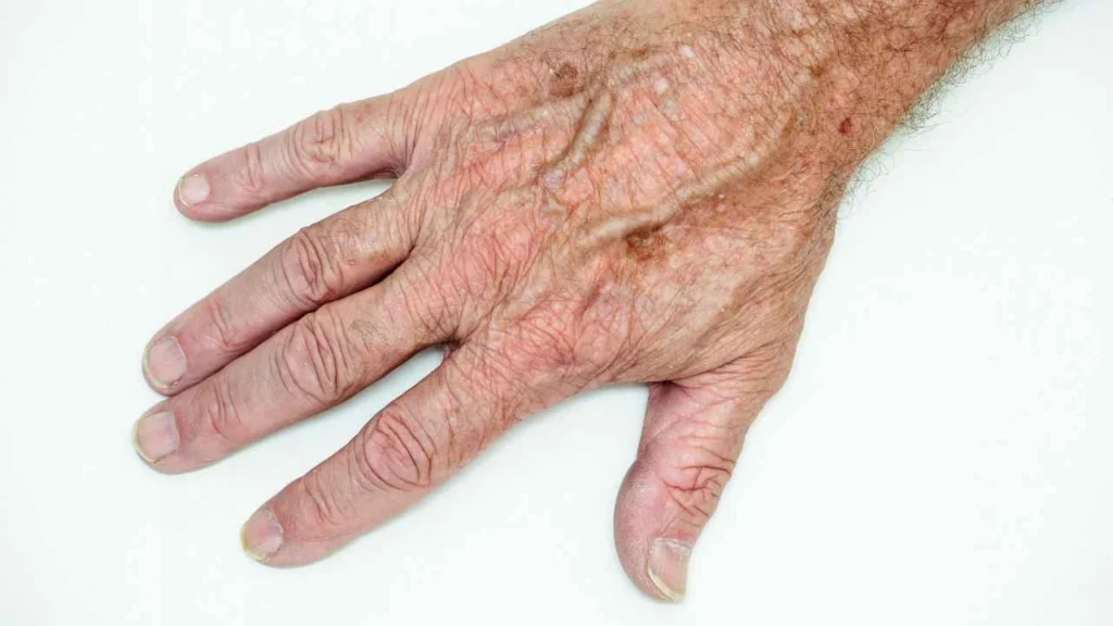 Male hand showing age spot Little Bognor