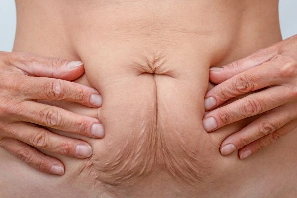 Image of a woman's stomach with loose skin - example of skin tightening Little Bognor options