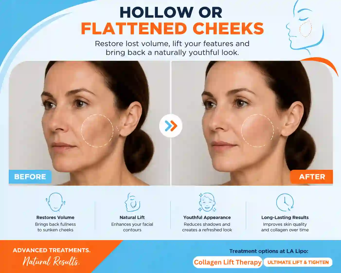 Sign #4: Hollow or Flattened Cheeks Little Bognor