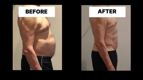 What Symptoms Can Diastasis Recti Cause in Men? Weak Core, Back Pain and Poor Posture Little Bognor